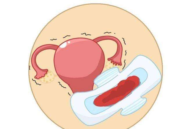 像脓一样还伴有臭味……发生这种情况的你可能有宫颈息肉或宫颈炎